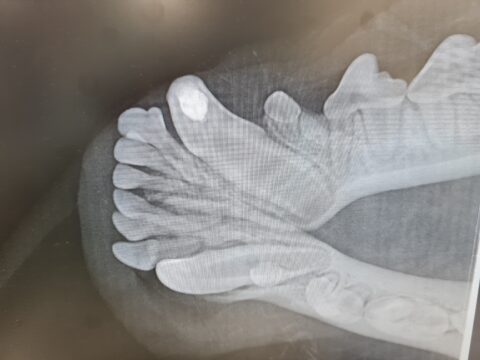 pulpa-amputoitu hammas röntgenkuva